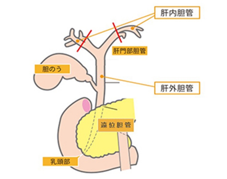 胆道外科｜富山大学での治療｜富山大学附属病院 消化器・腫瘍・総合外科（第二外科） Bildidee 